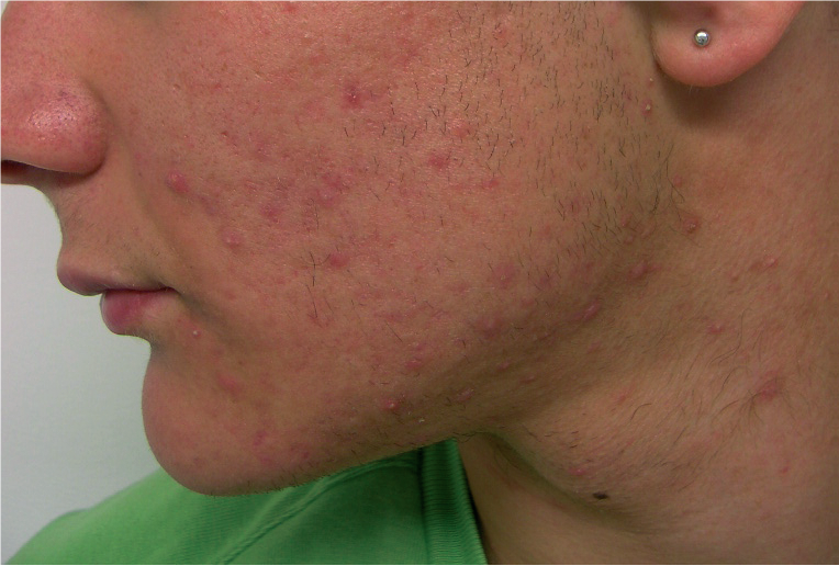 Radiofrequenza acne attiva risultato 2